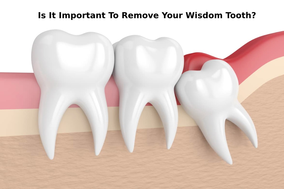 Is It Important To Remove Your Wisdom Tooth? -2023