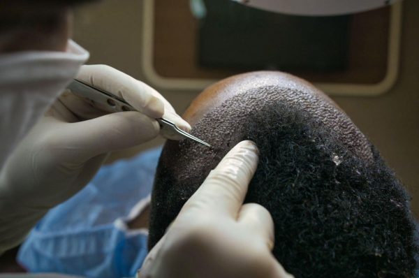 Questions You Should Ask Before A Hair Transplant - 2023